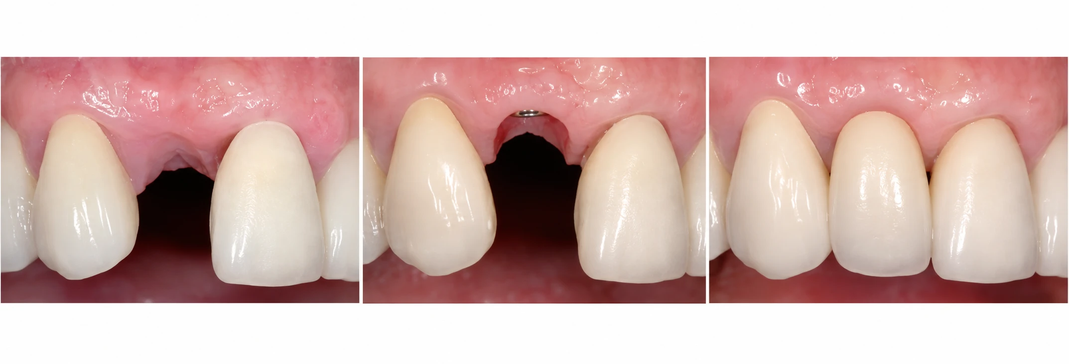 Einzelzahnimplantat im Frontzahnbereich: Lücke, Implantatphase und definitive Krone