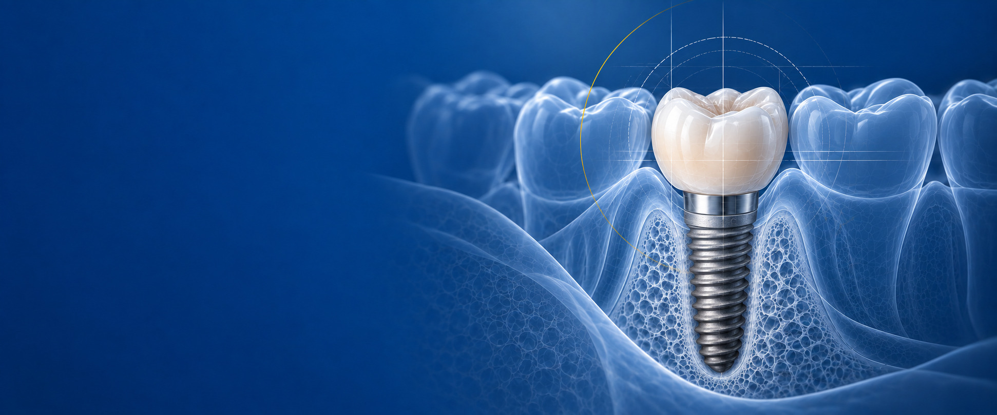 Implantatdarstellung im Kiefer als Hero-Bild für Implantologie
