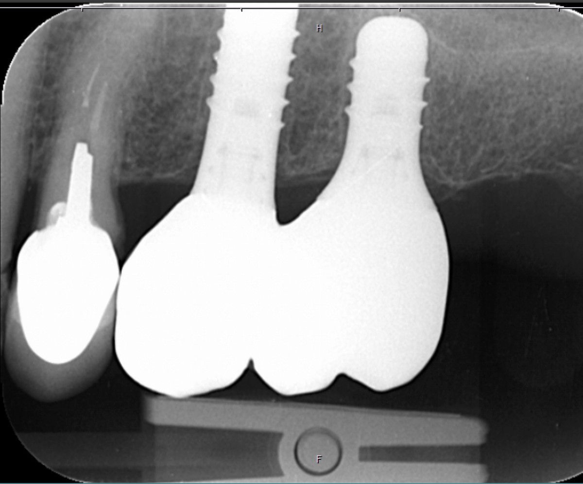 Röntgenbild mit Implantaten und festsitzender Versorgung