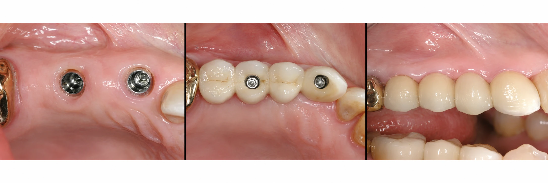 Implantatgetragene Versorgung im Seitenzahnbereich: Implantate und definitive Versorgung