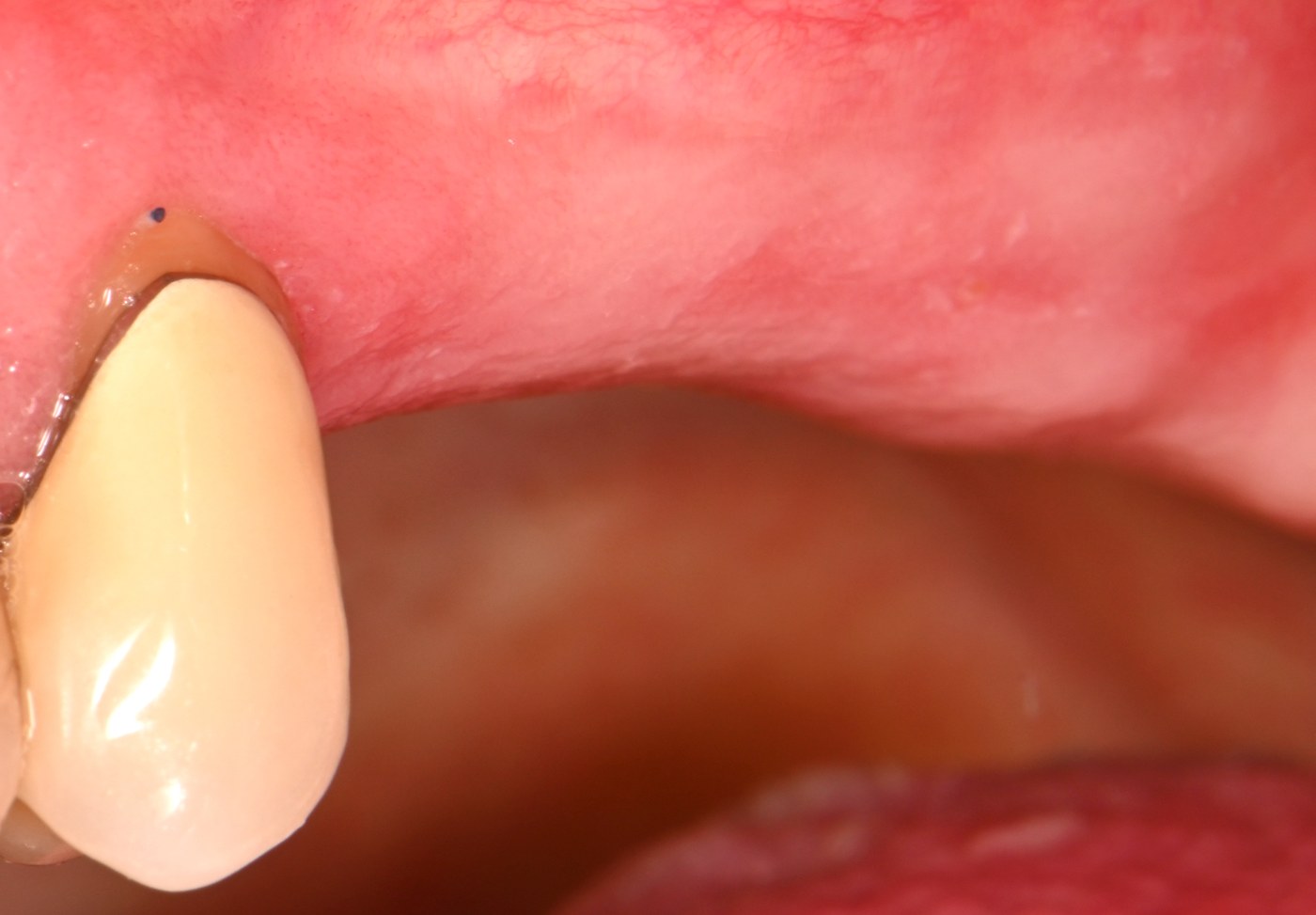 Fehlende Seitenzähne vor der implantatgetragenen Versorgung
