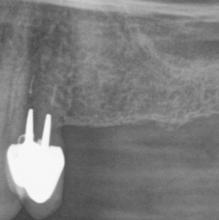 Röntgenbild vor der Implantatversorgung